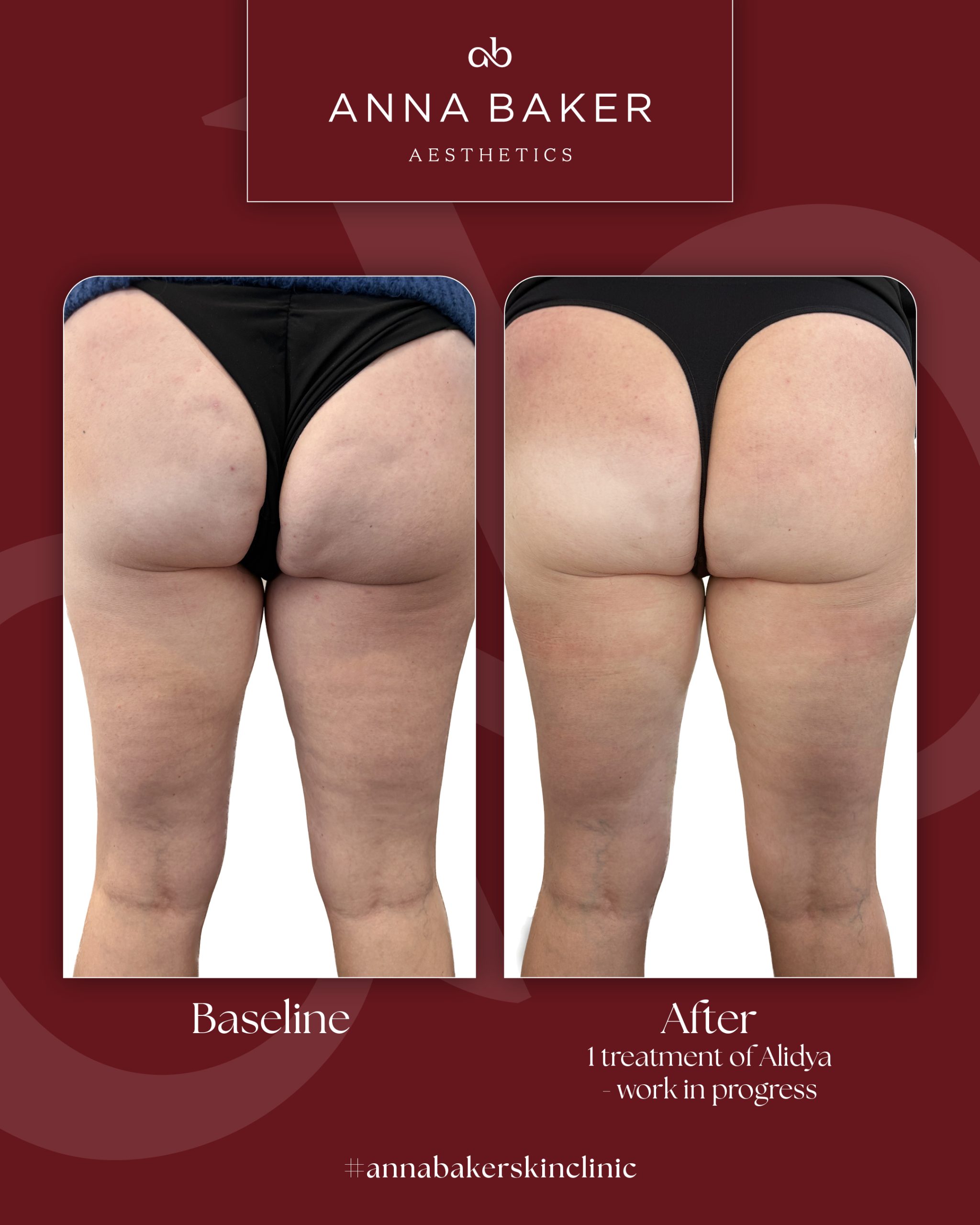 1080x1350 B&A